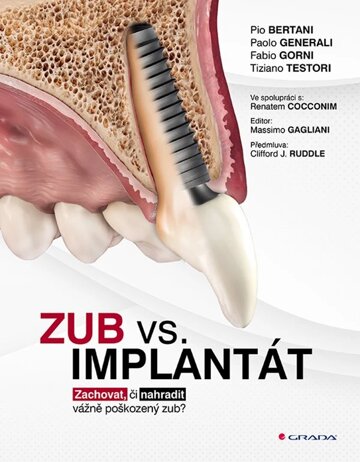Obálka knihy Zub vs. implantát