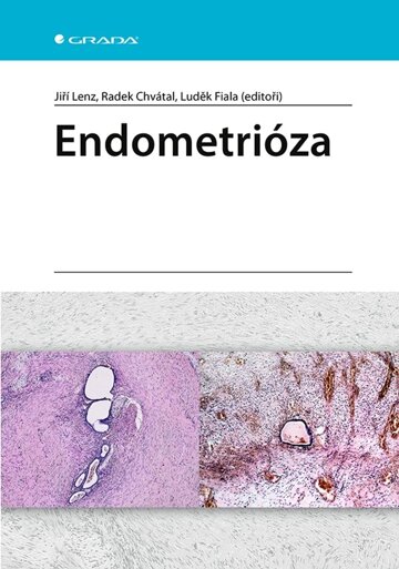 Obálka knihy Endometrióza
